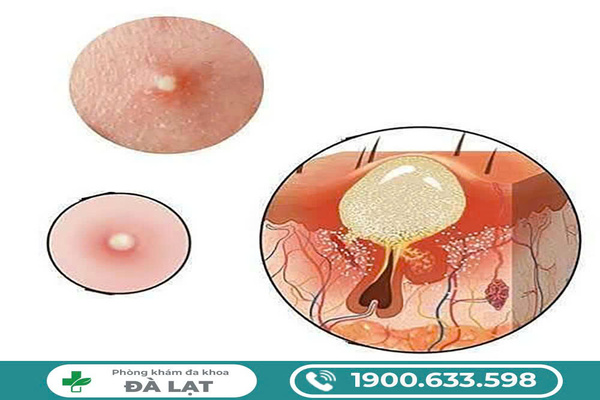 Mọc Mụn Ở Môi Cô Bé 